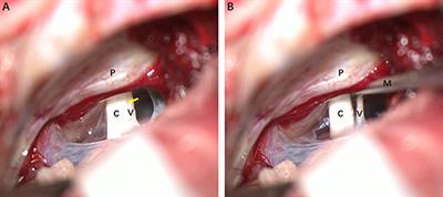 Subcellular Abnormalities of Vestibular Nerve Morphology in Patients With Intractable Meniere's Disease